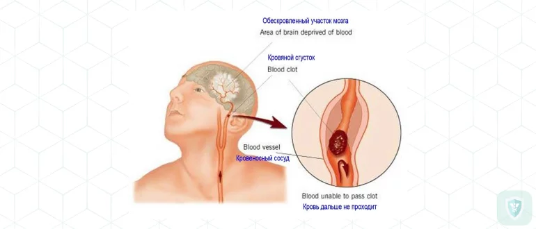 Появление менингеальных и очаговых симптомов