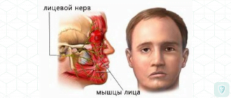 Невропатия лицевого нерва. Лечение