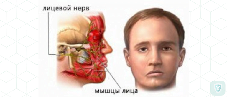 Невропатия лицевого нерва. Лечение