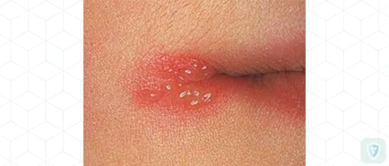 Герпес и его носители