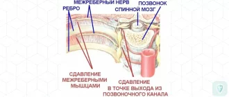 Гриппозная токсическая межреберная невралгия