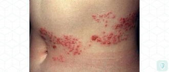 Гриппозный токсический ганглионит звездчатого узла