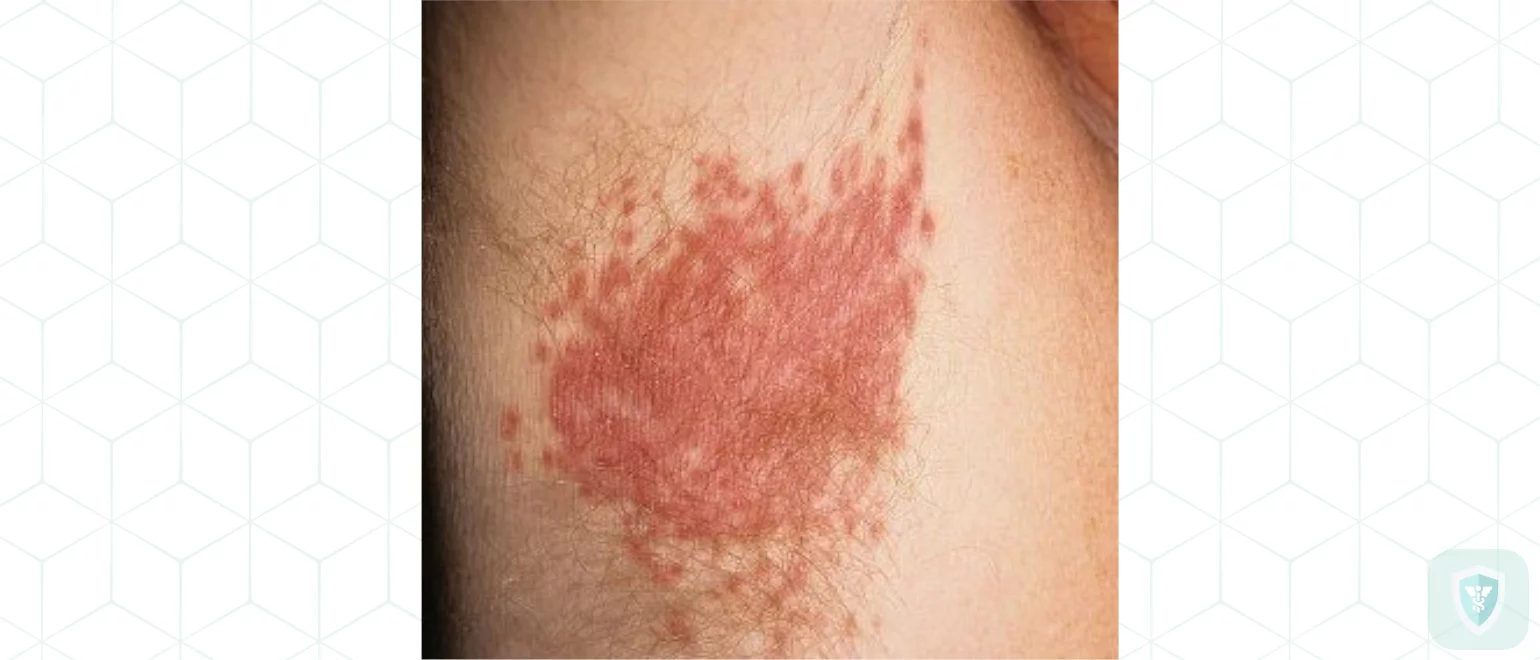 С кандидозом не по пути