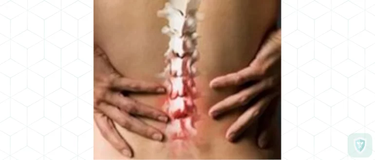 Остеохондроз