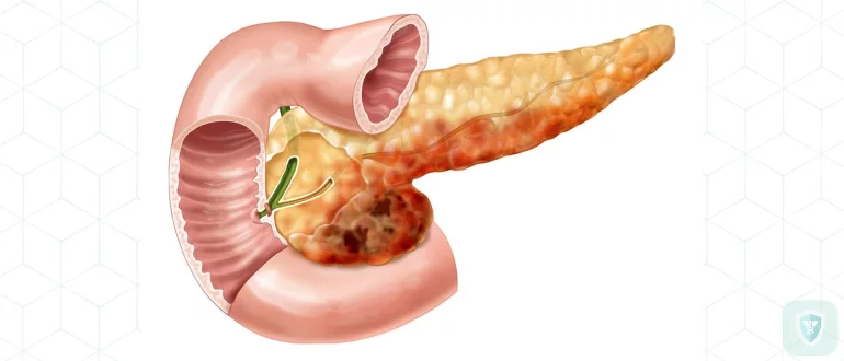 Панкреатит