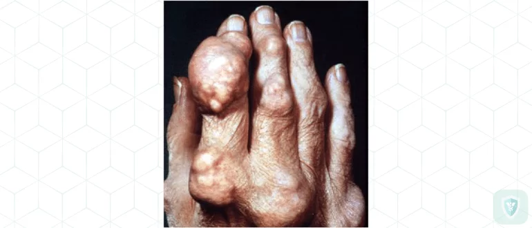 Подагра – проблема, о которой стоит говорить