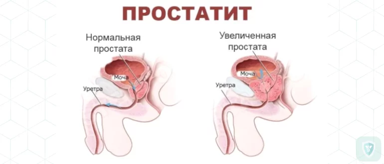 Простатит