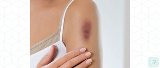 Cиняки на теле: причины, лечение