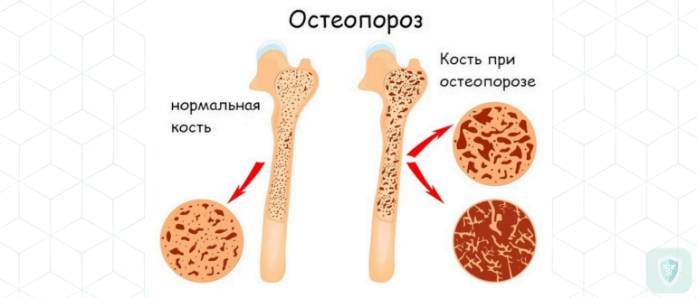 Для чего используется денситометрия костей?