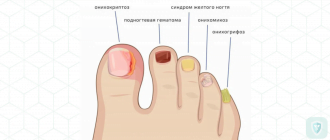Лечение грибка ногтей народными средствами