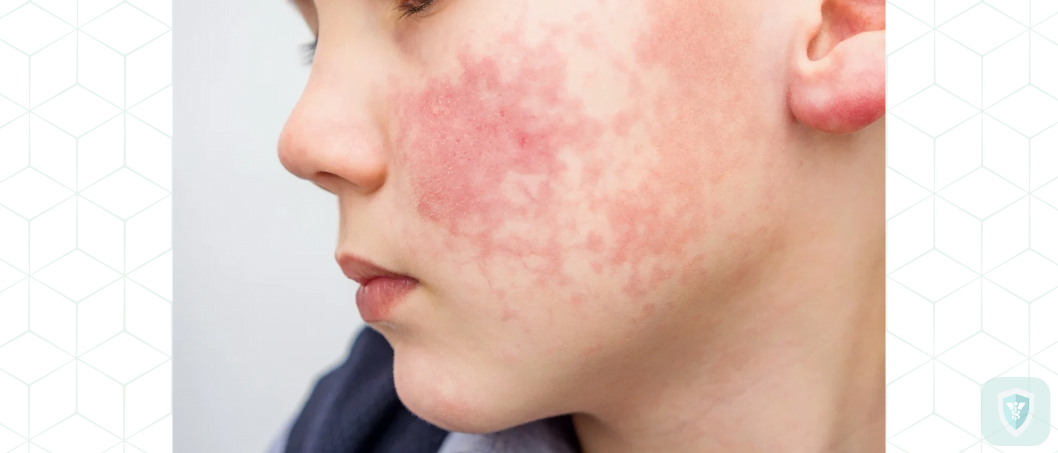 Что такое аллергия на холод, и как с ней бороться