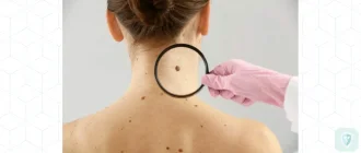 Безопасно ли удалять родинки во время беременности?