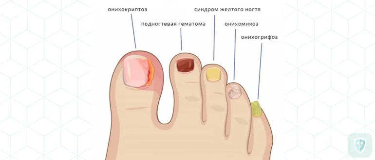 Как вылечить грибок ногтей