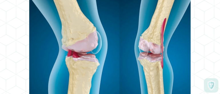Боль в суставах: как проявляется остеоартрит