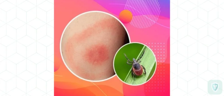 Лечение болезни Лайма