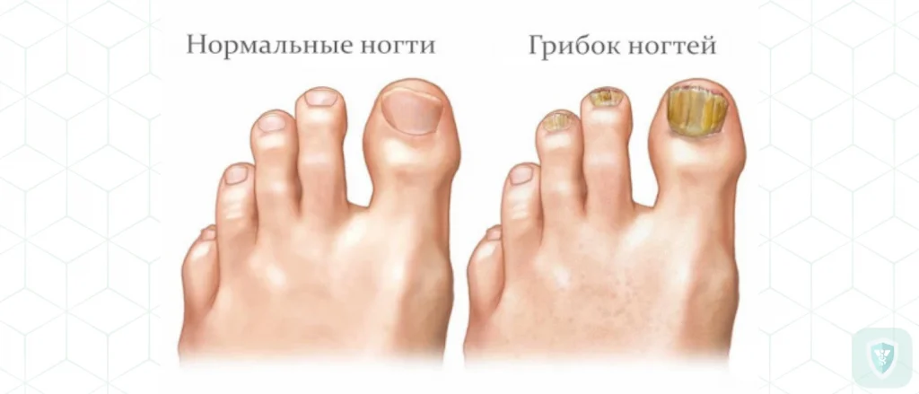 Как вылечить грибок ногтей